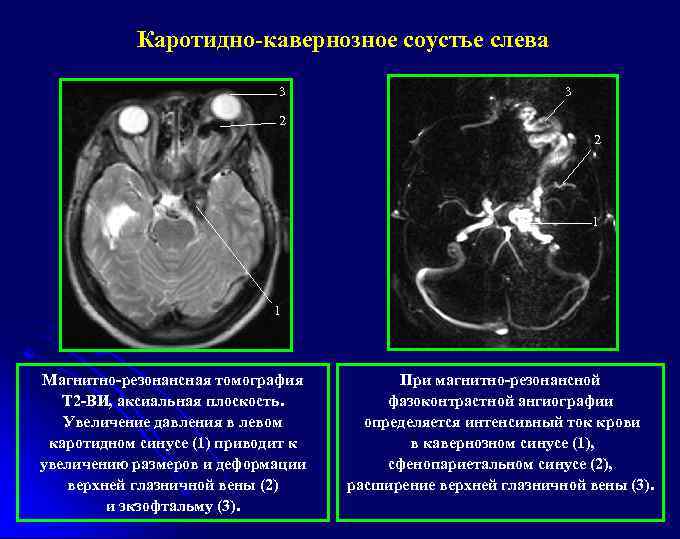 Каротидно-кавернозное соустье слева 3 3 2 2 1 1 Магнитно-резонансная томография Т 2 -ВИ,