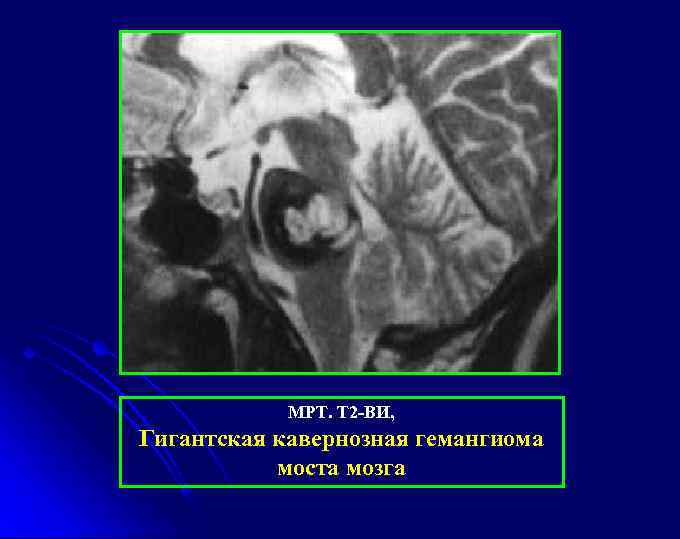 МРТ. Т 2 -ВИ, Гигантская кавернозная гемангиома моста мозга 