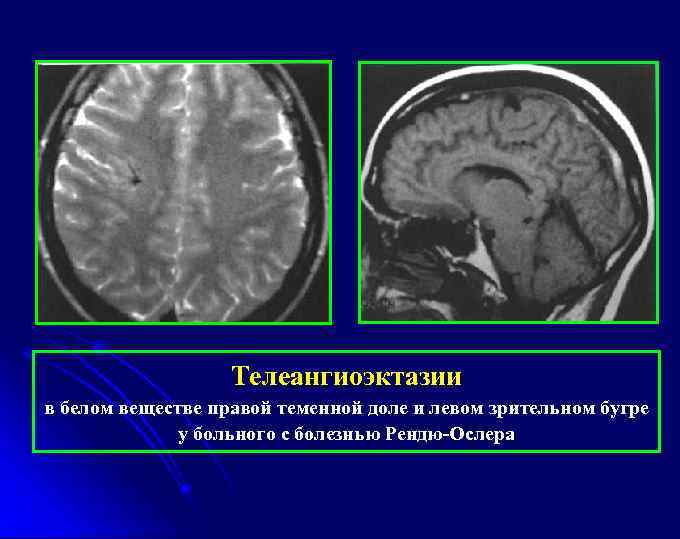 Телеангиоэктазии в белом веществе правой теменной доле и левом зрительном бугре у больного с