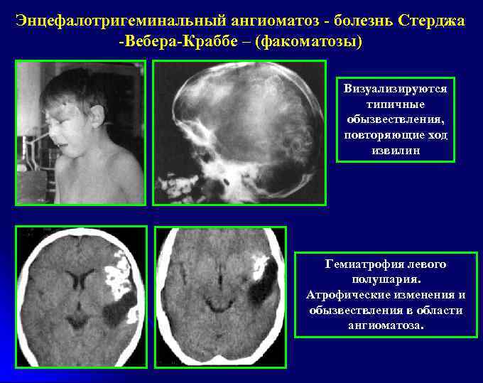Энцефалотригеминальный ангиоматоз - болезнь Стерджа -Вебера-Краббе – (факоматозы) Визуализируются типичные обызвествления, повторяющие ход извилин