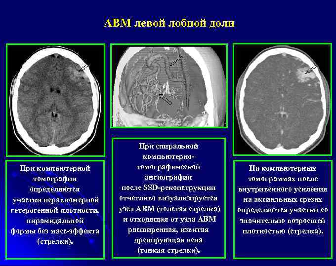 АВМ левой лобной доли При компьютерной томографии определяются участки неравномерной гетерогенной плотности, пирамидальной формы