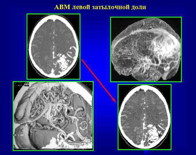 АВМ левой затылочной доли 
