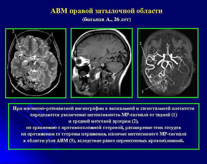 АВМ правой затылочной области (больная А. , 26 лет) 2 1 3 3 При