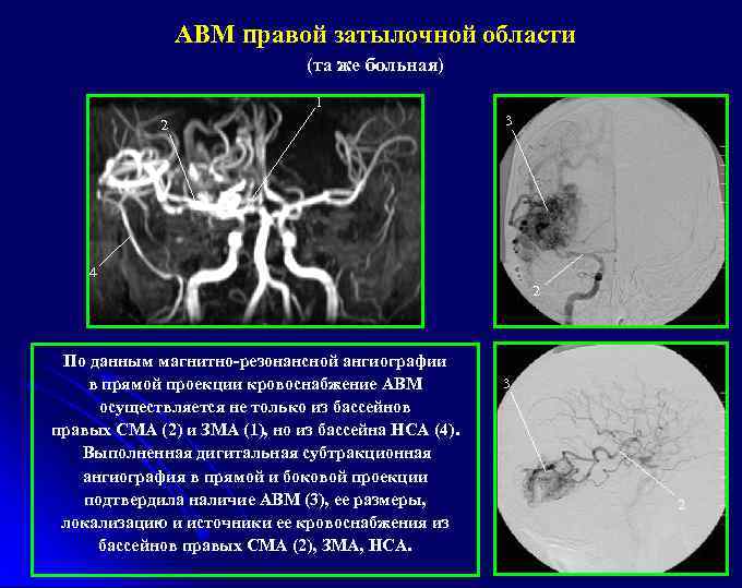 АВМ правой затылочной области (та же больная) 1 2 3 4 2 По данным