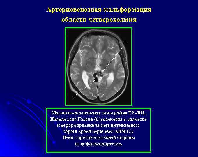Артериовенозная мальформация области четверохолмия 2 1 Магнитно-резонансная томография Т 2 –ВИ. Правая вена Галена