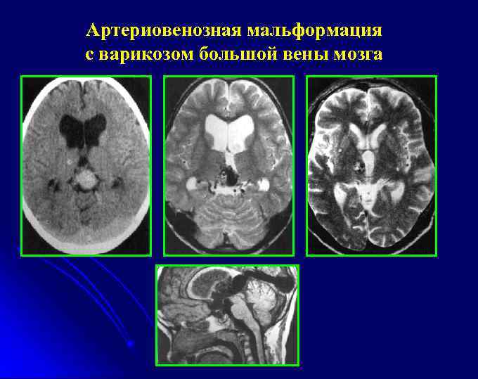 Мальформация сосудов головного мозга фото
