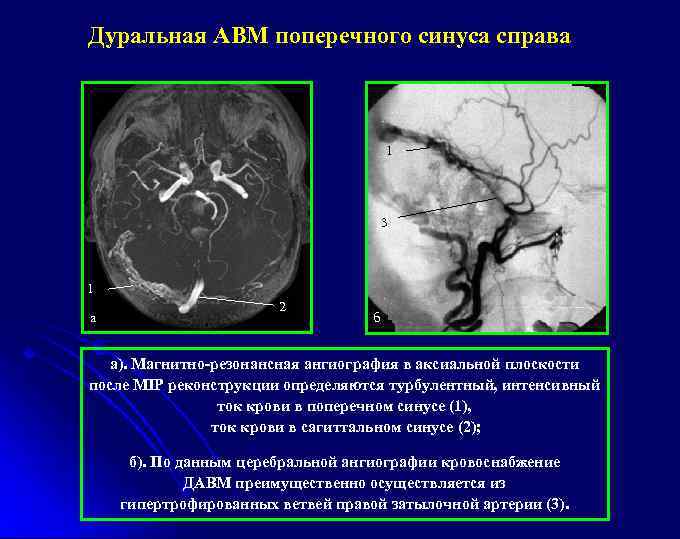 Дуральная АВМ поперечного синуса справа 1 3 1 а 2 б а). Магнитно-резонансная ангиография