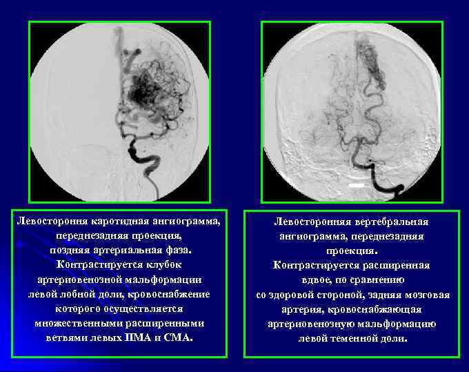 Левостороння каротидная ангиограмма, переднезадняя проекция, поздняя артериальная фаза. Контрастируется клубок артериовенозной мальформации левой лобной
