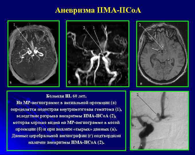 Аневризма ПМА-ПСо. А 1 а 2 2 1 б Больная Ш. 60 лет. На