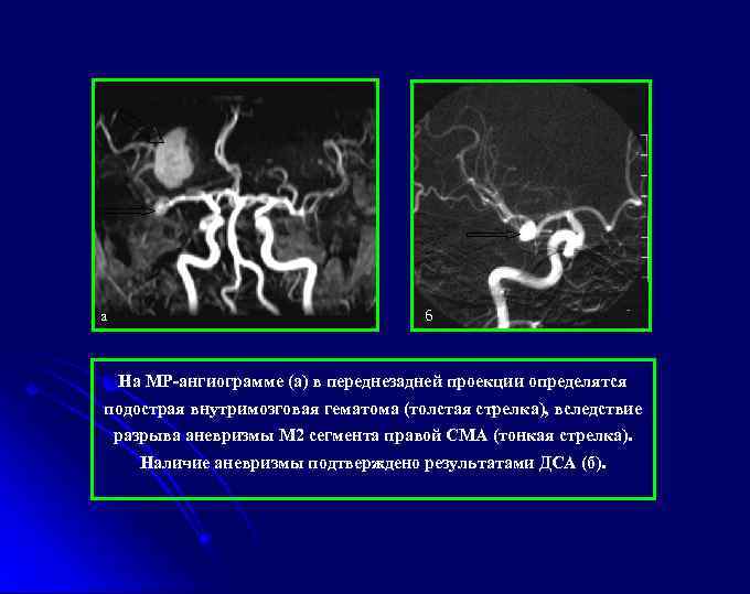 а б На МР-ангиограмме (а) в переднезадней проекции определятся подострая внутримозговая гематома (толстая стрелка),