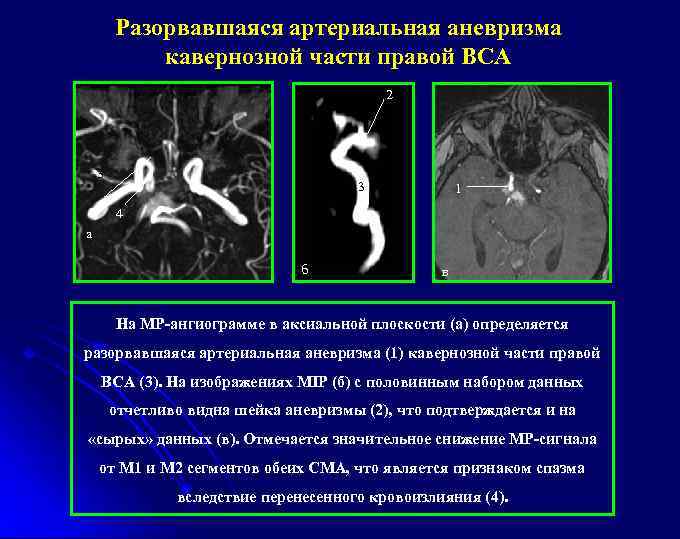 Разорвавшаяся артериальная аневризма кавернозной части правой ВСА 2 3 1 4 а б в