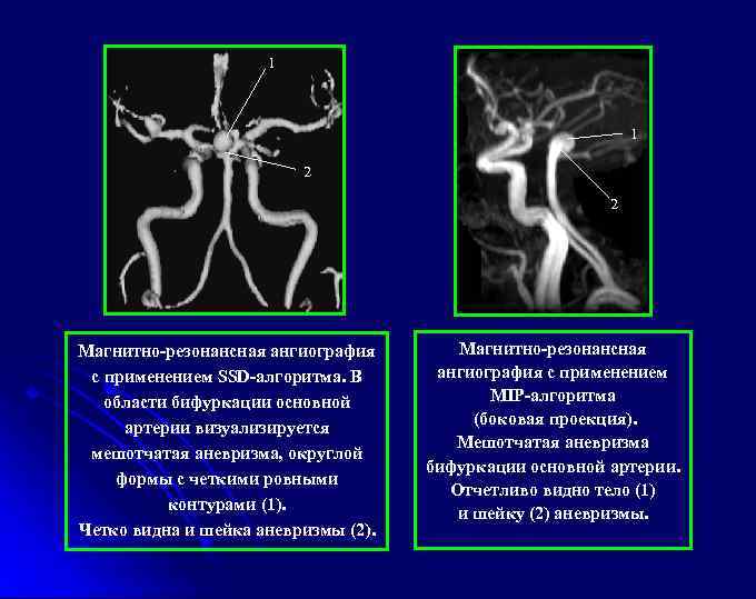 1 1 2 2 Магнитно-резонансная ангиография с применением SSD-алгоритма. В области бифуркации основной артерии