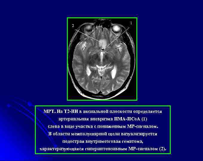 2 1 МРТ. На Т 2 -ВИ в аксиальной плоскости определяется артериальная аневризма ПМА-ПСо.