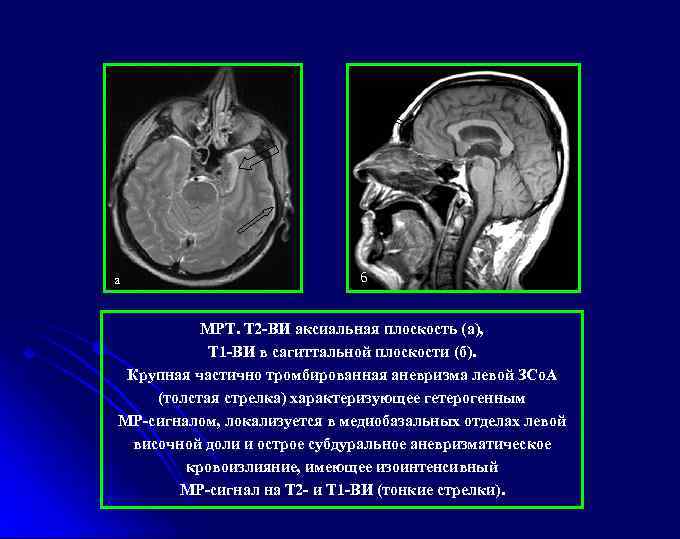 а б МРТ. Т 2 -ВИ аксиальная плоскость (а), Т 1 -ВИ в сагиттальной