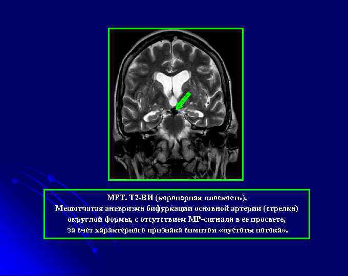 МРТ. Т 2 -ВИ (коронарная плоскость). Мешотчатая аневризма бифуркации основной артерии (стрелка) округлой формы,