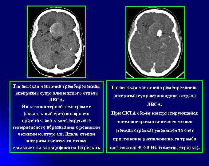 Гигантская частично тромбированная аневризма супраклиноидного отдела ЛВСА. На компьютерной томограмме (аксиальный срез) аневризма представлена