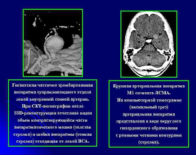 Гигантская частично тромбированная Крупная артериальная аневризма супраклиноидного отдела М 1 сегмента ЛСМА. левой внутренней