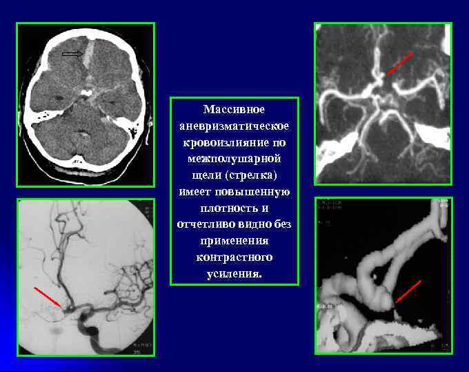 Массивное аневризматическое кровоизлияние по межполушарной щели (стрелка) имеет повышенную плотность и отчетливо видно без