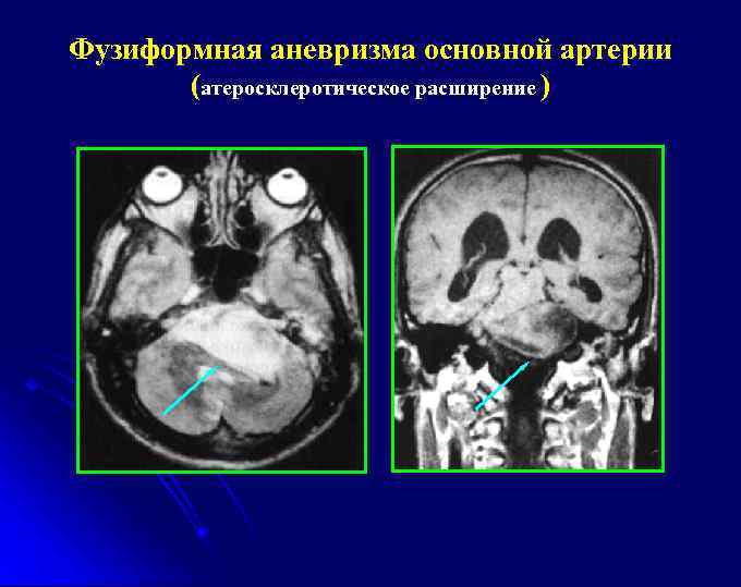 Фузиформная аневризма основной артерии (атеросклеротическое расширение ) 