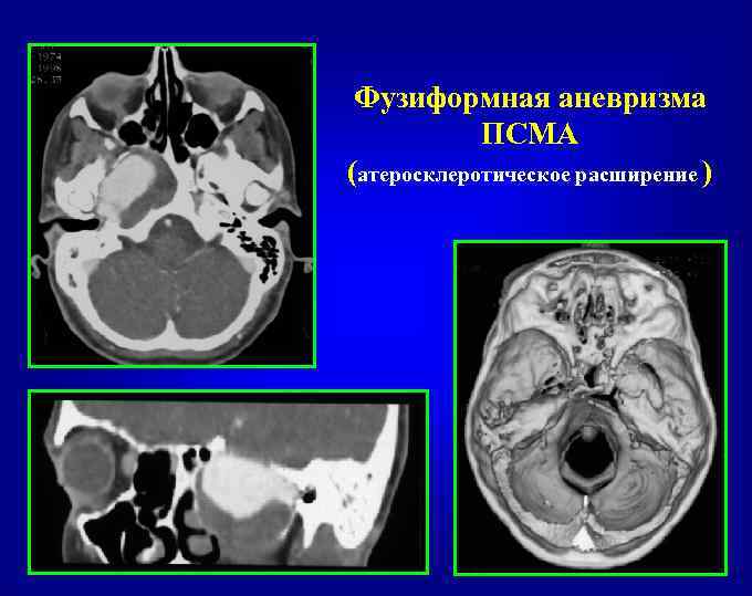 Фузиформная аневризма ПСМА (атеросклеротическое расширение ) 