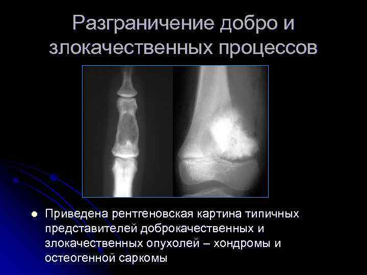 Разграничение добро и злокачественных процессов l Приведена рентгеновская картина типичных представителей доброкачественных и злокачественных