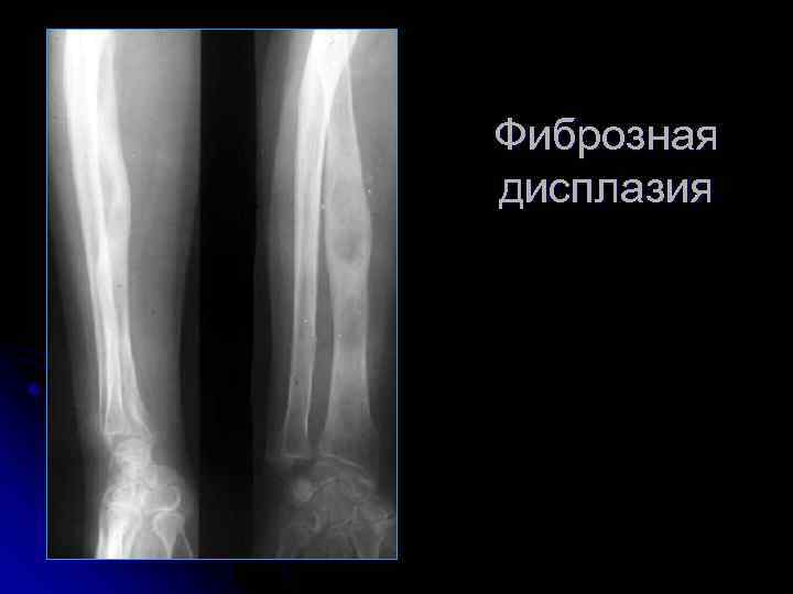 Фиброзная дисплазия 