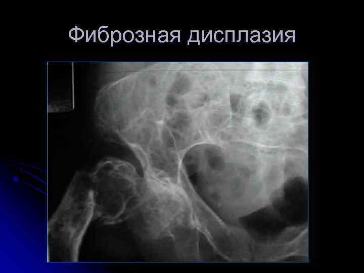 Фиброзная дисплазия 