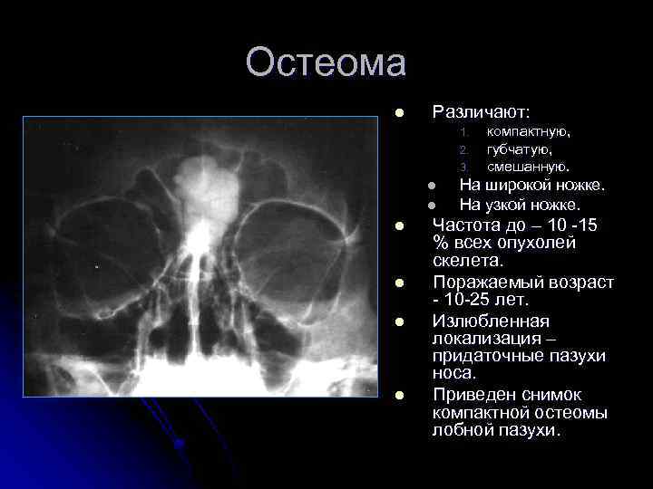 Остеома l Различают: 1. 2. 3. l l l компактную, губчатую, смешанную. На широкой