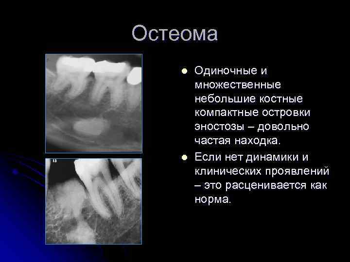 Остеома l l Одиночные и множественные небольшие костные компактные островки эностозы – довольно частая