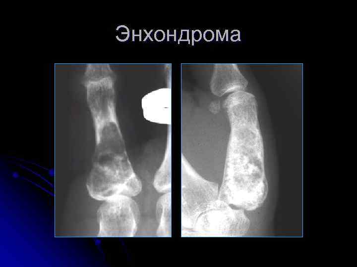 Энхондрома 