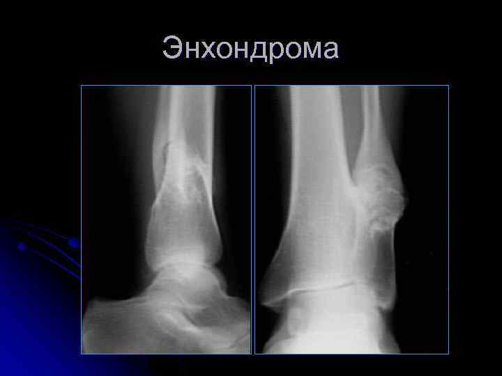 Энхондрома 