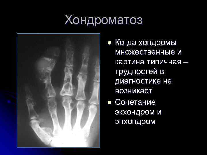 Хондроматоз l l Когда хондромы множественные и картина типичная – трудностей в диагностике не