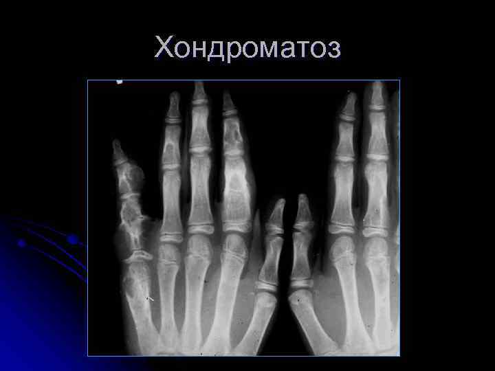 Хондроматоз 