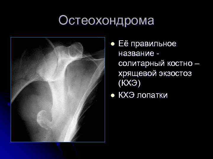 Остеохондрома l l Её правильное название - солитарный костно – хрящевой экзостоз (КХЭ) КХЭ
