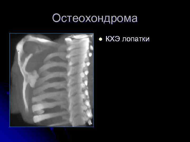 Остеохондрома l КХЭ лопатки 