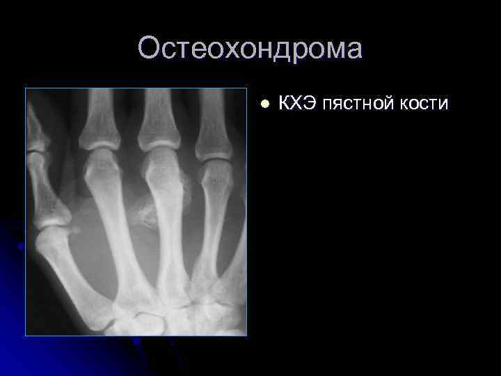 Остеохондрома l КХЭ пястной кости 