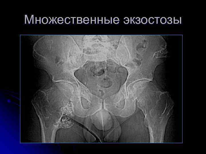 Множественные экзостозы 