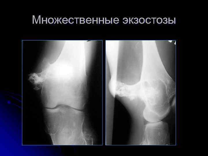 Множественные экзостозы 