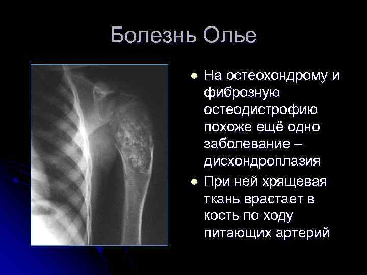 Болезнь Олье l l На остеохондрому и фиброзную остеодистрофию похоже ещё одно заболевание –