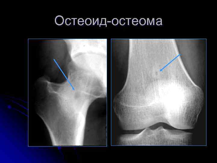 Остеоид-остеома 