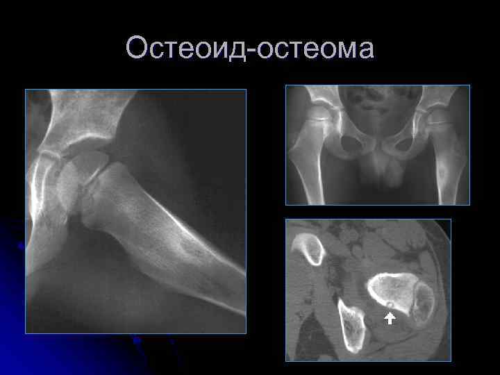 Остеоид-остеома 