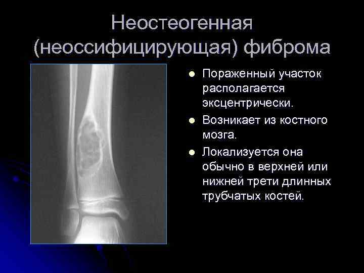 Неостеогенная (неоссифицирующая) фиброма l l l Пораженный участок располагается эксцентрически. Возникает из костного мозга.