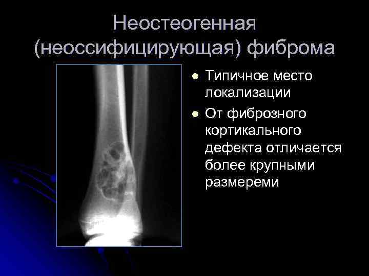 Неостеогенная (неоссифицирующая) фиброма l l Типичное место локализации От фиброзного кортикального дефекта отличается более
