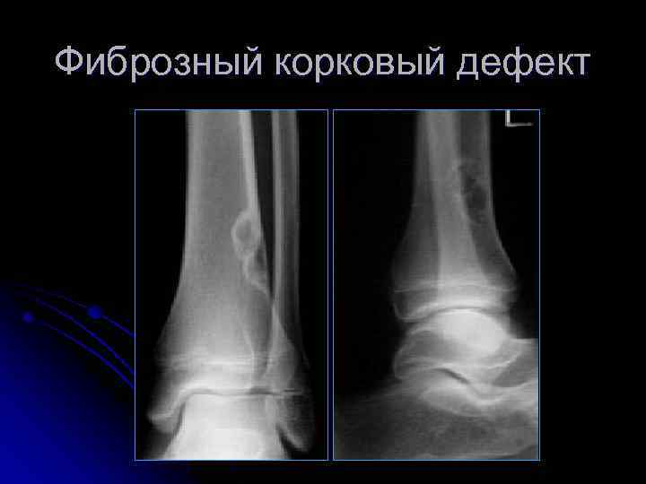 Фиброзный корковый дефект 