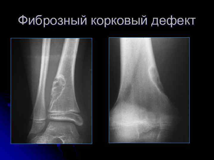 Фиброзный корковый дефект 