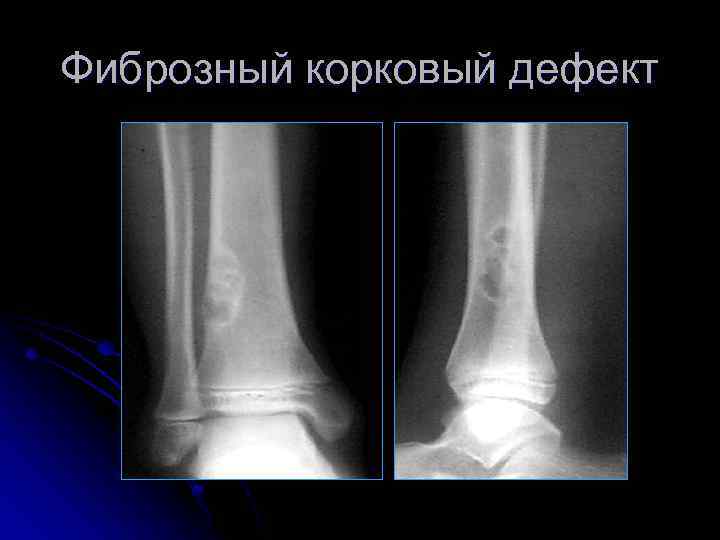 Фиброзный корковый дефект 