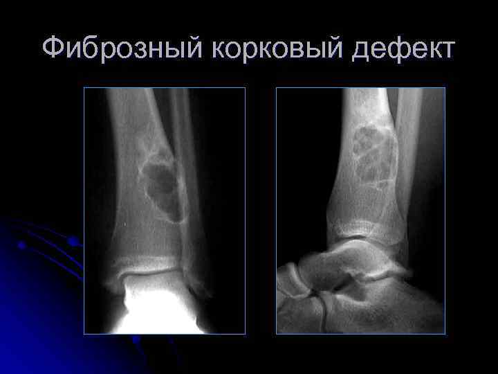 Фиброзный корковый дефект 