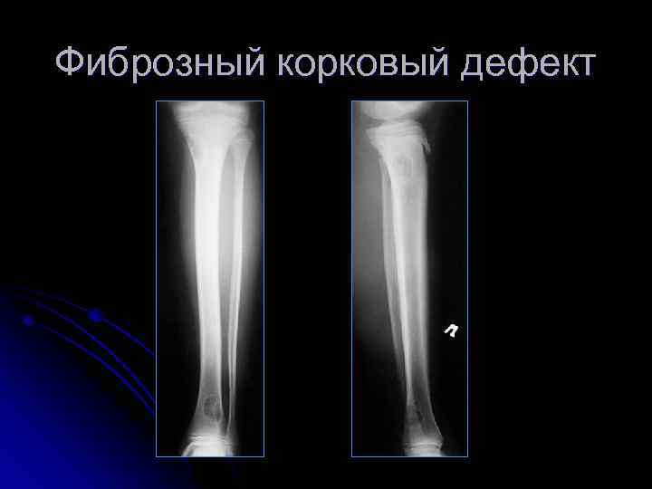 Фиброзный корковый дефект 