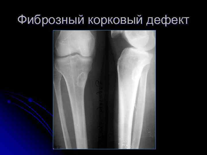 Фиброзный корковый дефект 