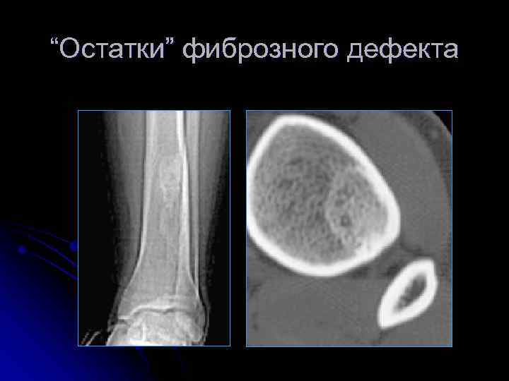 “Остатки” фиброзного дефекта 